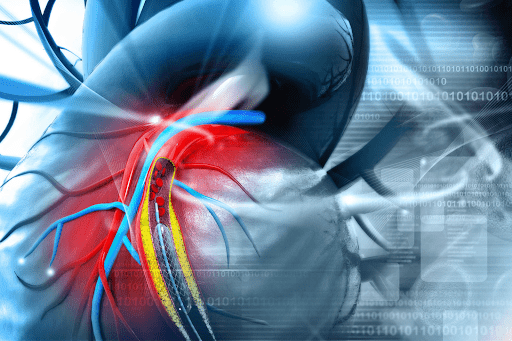 Tăng huyết áp gây nên biến chứng thiếu máu cơ tim - bệnh tim mạch vành